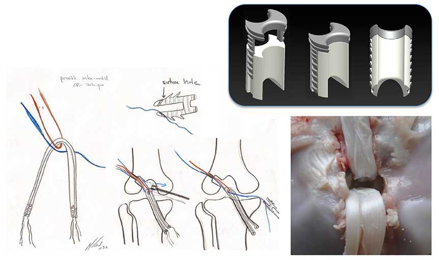 Enlarged view: Novel approaches to soft tissue fixation.  Sketch courtesy Prof. Dr. Mazda Farshad.